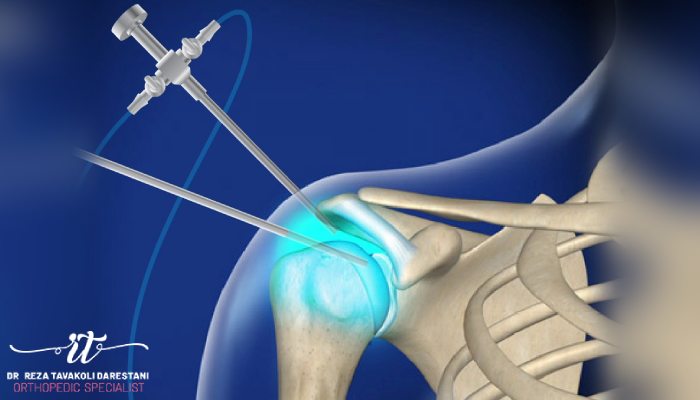 کاربردهای جراحی آرتروسکوپی شانه