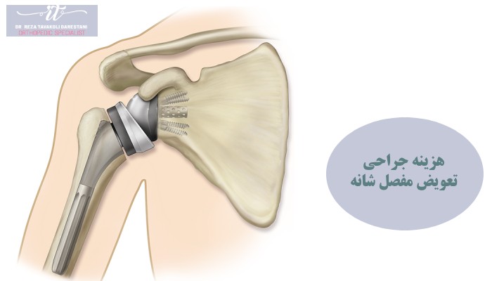 هزینه جراحی تعویض مفصل شانه