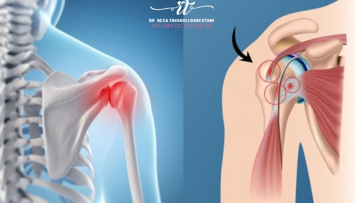 سندروم گیرافتادگی شانه چیست؟