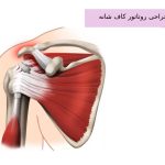 جراحی روتاتور کاف شانه