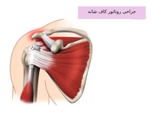 جراحی روتاتور کاف شانه