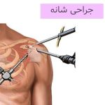 جراحی شانه