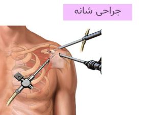 جراحی شانه