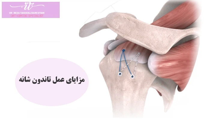 مزایای عمل تاندون شانه
