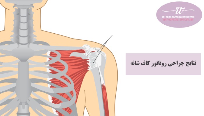 نتایج جراحی روتاتور کاف شانه
