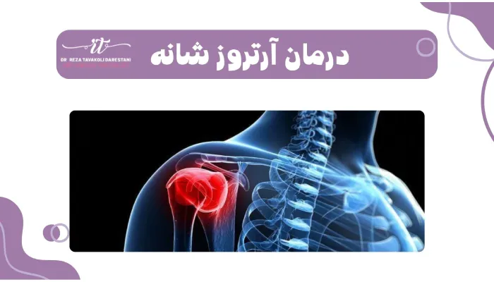 درمان آرتروز شانه چیست؟
