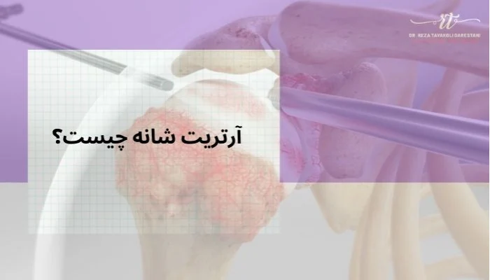 آرتریت شانه چیست؟