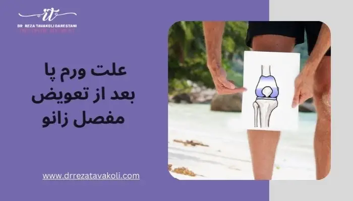 علت ورم پا بعد از تعویض مفصل زانو