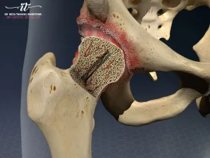 نکروز آواسکولار