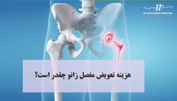 هزینه تعویض مفصل زانو چقدر است؟