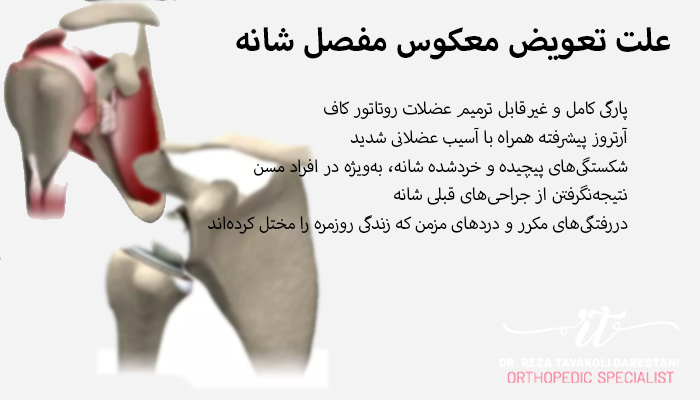 لیستی از علت تعویض معکوس مفصل شانه