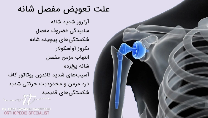 فهرست علت تعویض مفصل شانه با عکس آناتومی شانه