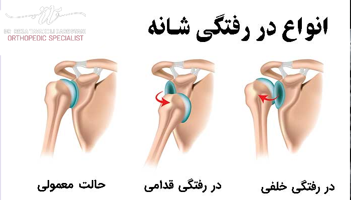 انواع دررفتگی شانه