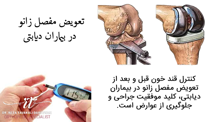 جراحی تعویض مفصل زانو در بیماران دیابتی