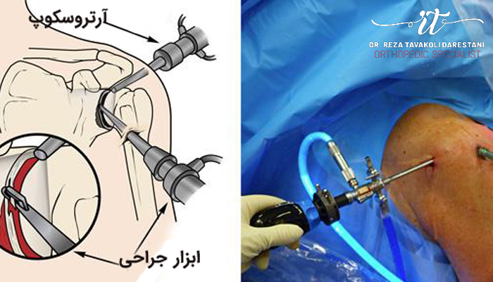 جراحی در رفتگی مکرر شانه