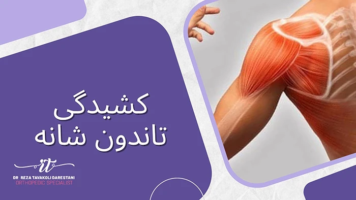 کشیدگی تاندون شانه چیست