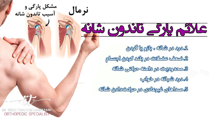 علائم پارگی تاندون شانه