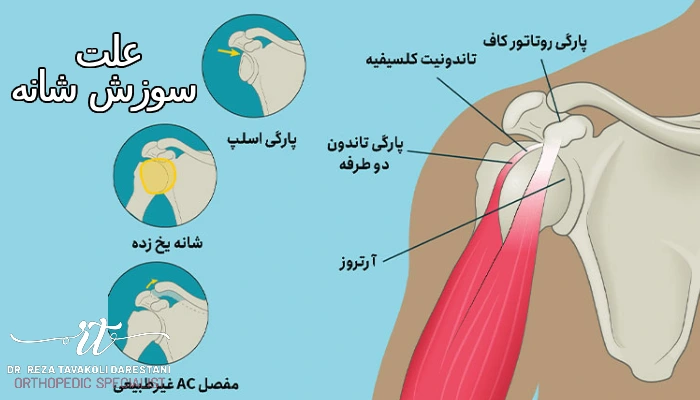 علت سوزش شانه