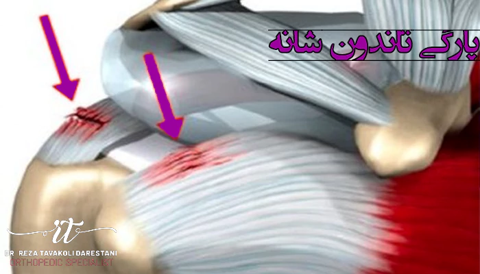 عکس پارگی تاندون شانه