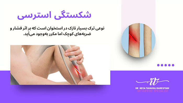 شکستگی استرسی چیست
